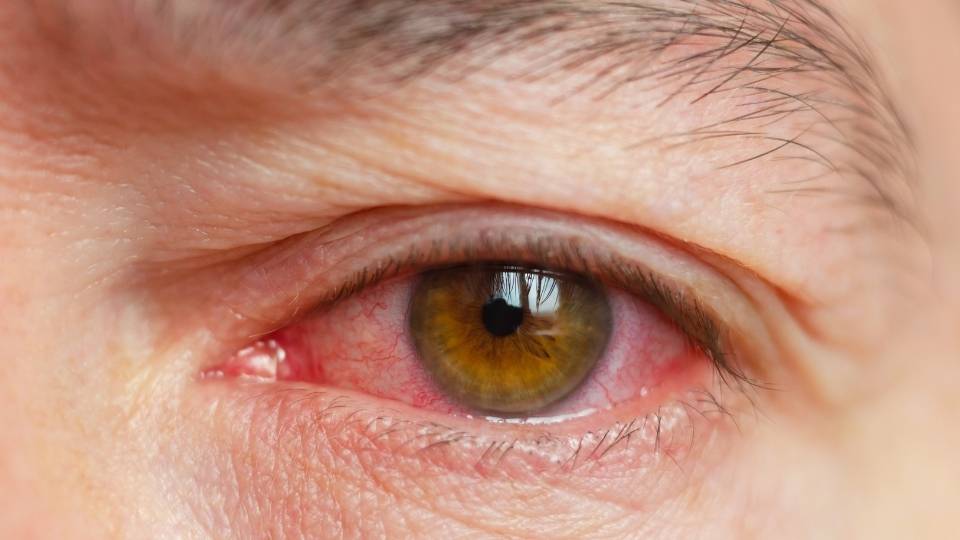 Alcoholic Face will have typical identifiers like facial swelling and red eyes.
