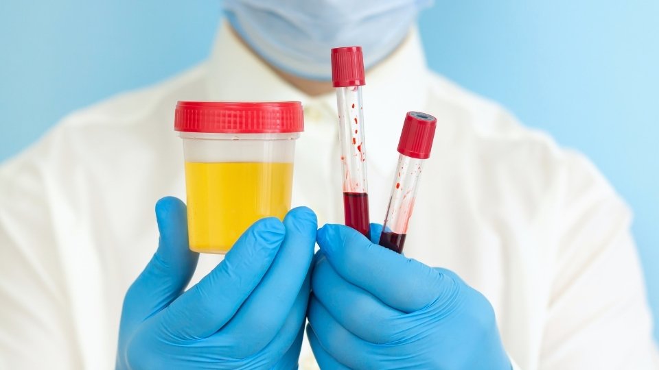 How Long Does Cocaine Stay in Your Urine a man holds blood and urine testes, which have different detection windows.