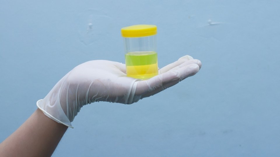 How Long Does Cocaine Stay in Your Urine a woman holds a urine sample which can be detected for cocaine up to 4 days of use typically.