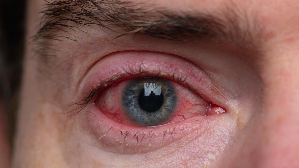 signs of cocaine use include things like bloodshot eyes