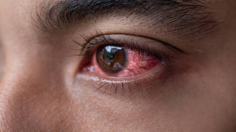 How to Tell If Someone Is on Meth hero image of a man with bloodshot eyes.