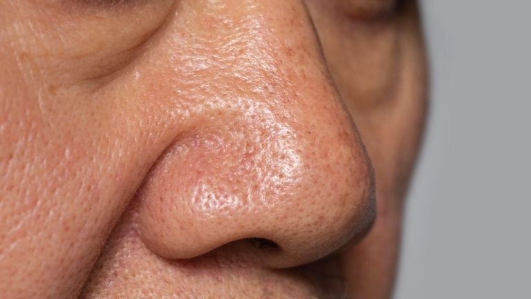 a man with a swollen nose after cocaine use.