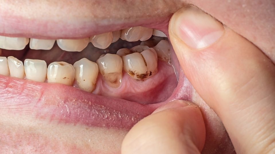 A man shows his decaying teeth from doing meth