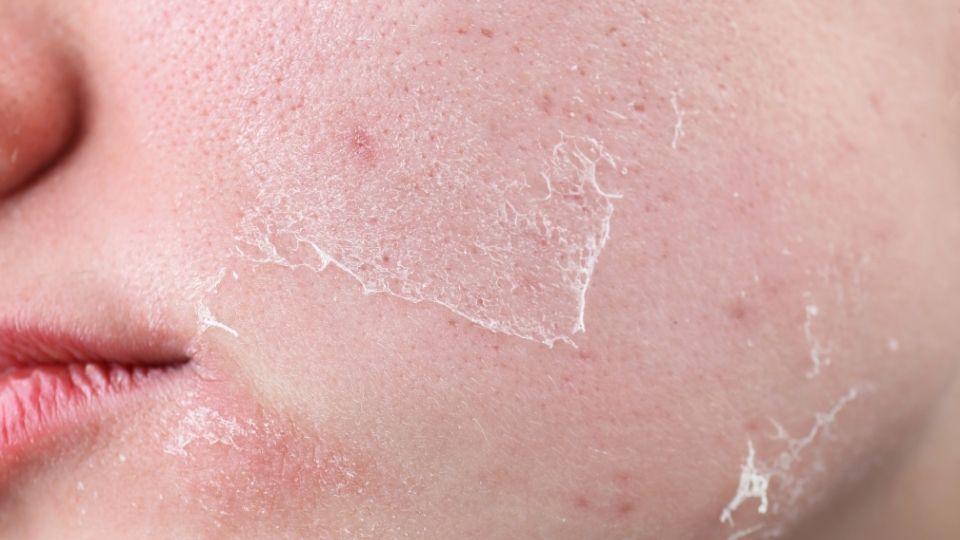 a woman experiences dry skin as a side effect of meth use.
