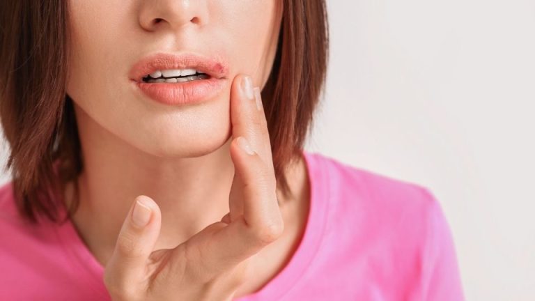 a woman has a meth sore on her face.