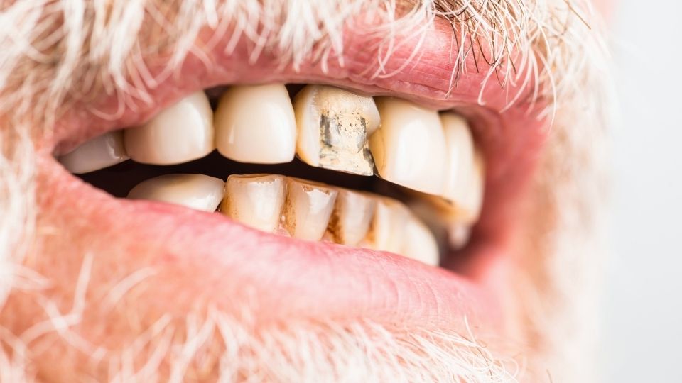 a man experiences bad teeth with meth mouth,